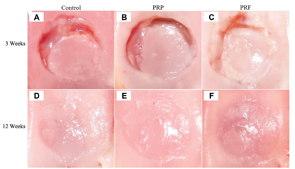 Platelet-rich plasma (PRP), platelet-rich fibrin (PRF)（F: PRF 使用例）の画像