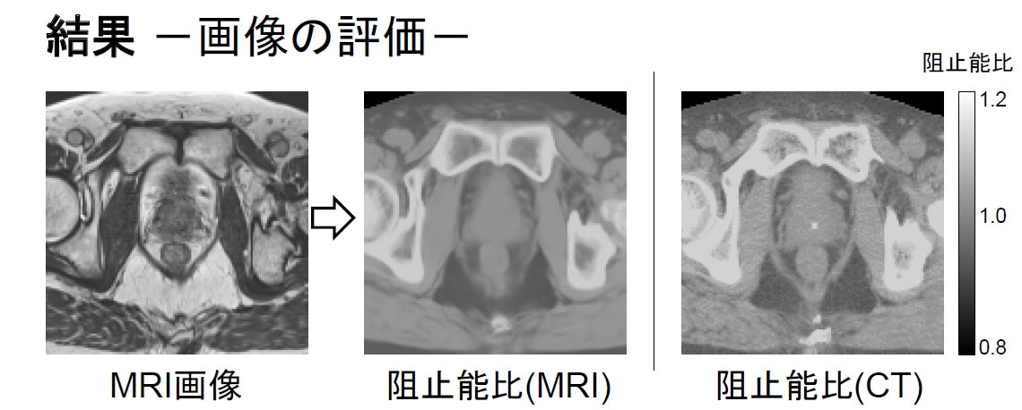 MRI画像（左）から深層学習で描出した炭素線阻止能比分布（中）と、実際の阻止能比分布（右）。深層学習により、良好な合成画像が得られている。の画像