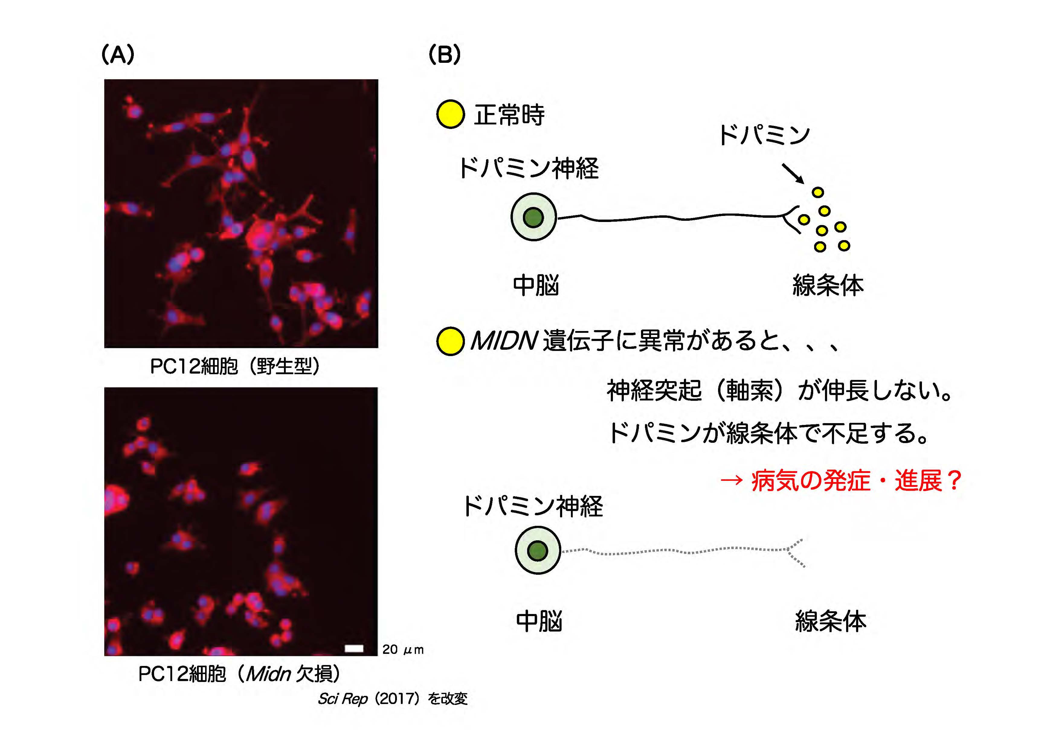 図2：<i>MIDN</i>遺伝子異常によるパーキンソン病の発症機構（仮説）。（A）神経のモデル細胞のPC12細胞（野生型）をNGFで刺激すると、神経突起を伸長して分化誘導されるが、<i>Midn</i>遺伝子を欠損した細胞では分化誘導されない。（B）中脳黒質のドパミン神経は線条体に投射してドパミンを分泌する。一方、<i>MIDN</i>遺伝子に異常があると、線条体への投射が出来ずにドパミンが不足し、病気の発症、進展の原因になることが予想される。の画像